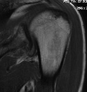 Shoulder MRI Normal Humeral IGHL Insertion